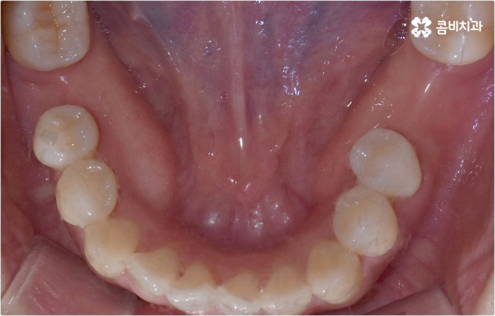 치아설측교정 보이지않아 좋아요 관련 이미지 9