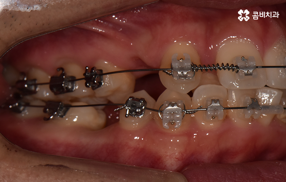 덧니 발치교정으로 교정할 때 치아가 이렇게 이동해요 관련 이미지 10