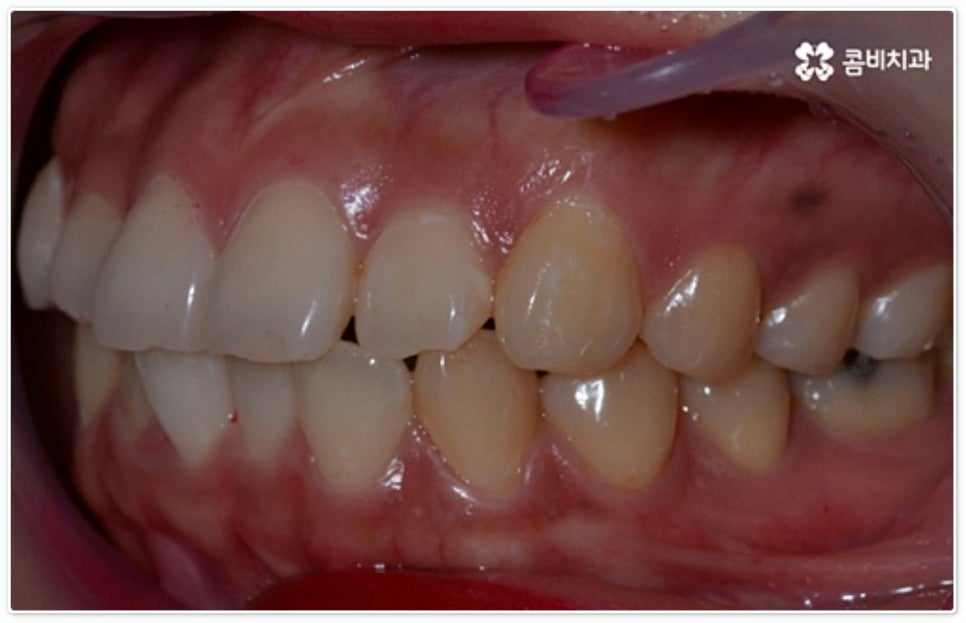 앞니부분교정 누구나 할수있나요? 관련 이미지 5