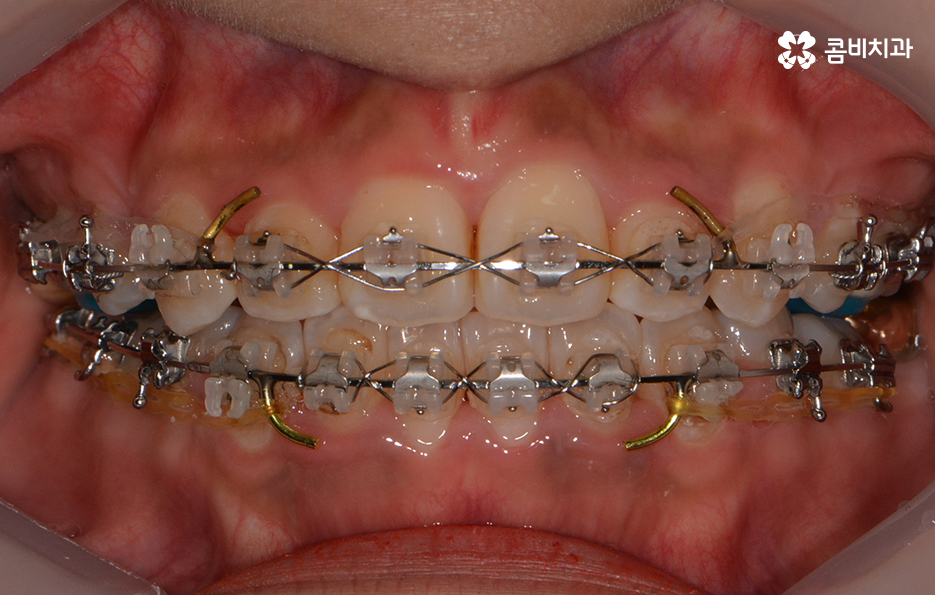 클리피씨교정 알아볼 때 꼭 신경 써야 하는 점은! 관련 이미지 9