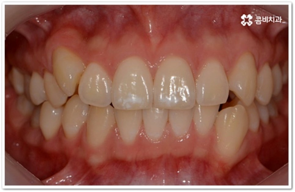 덧니 발치 언제 하나요? 관련 이미지 3