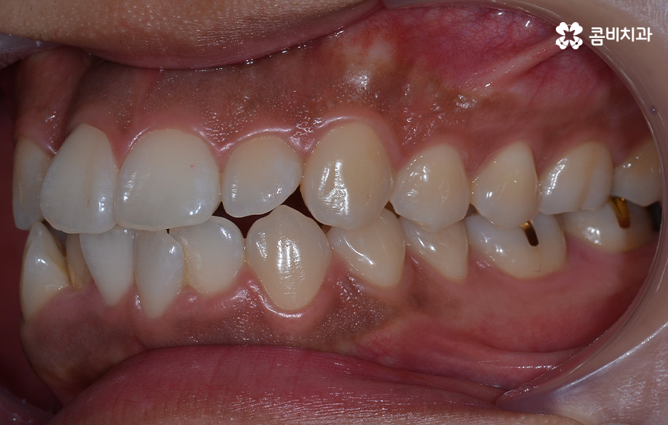 덧니 발치 교정 현명하게 선택하려면 관련 이미지 6