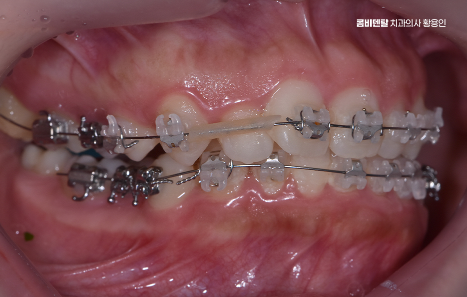 비발치 돌출입 교정 어떨때 적절할까 관련 이미지 8