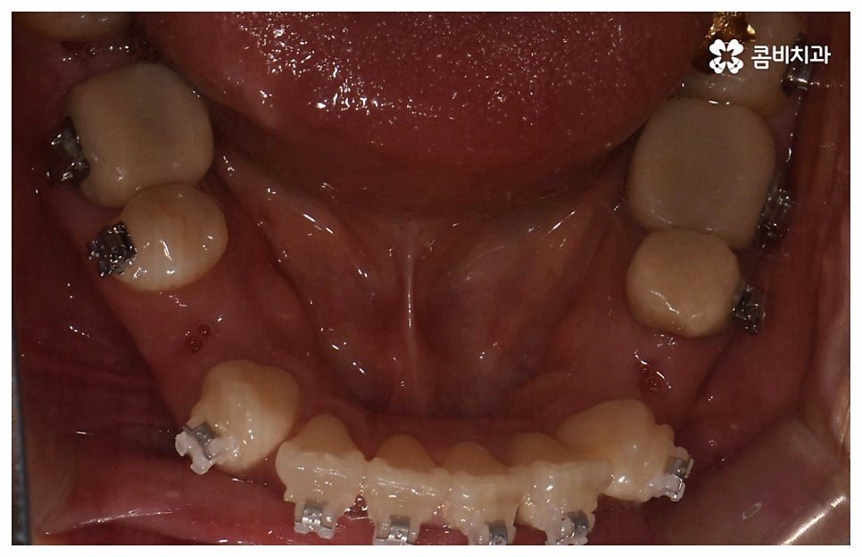 중년치아교정 원한다면 관련 이미지 10
