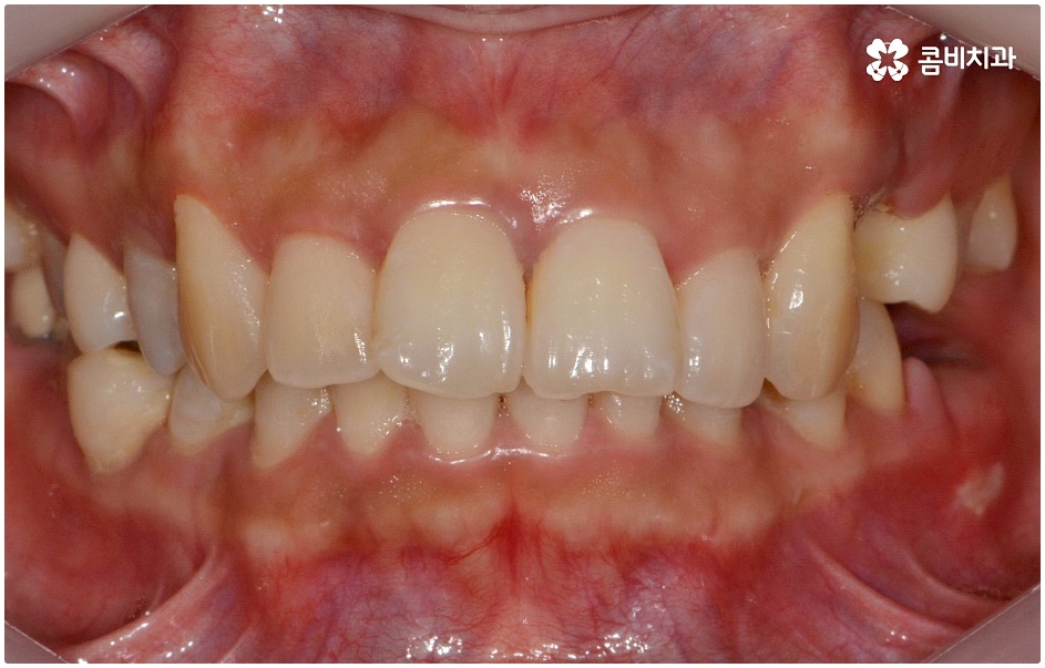 돌출치아교정 언제가 좋을까요 관련 이미지 3