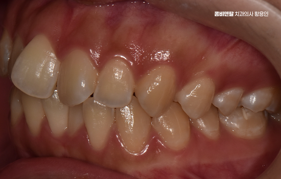 How Can You Determine the Duration of Front Teeth Orthodontic Treatment? image 5