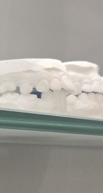 앞니 틀어짐 부분교정 얼마나 걸릴까 관련 이미지 27