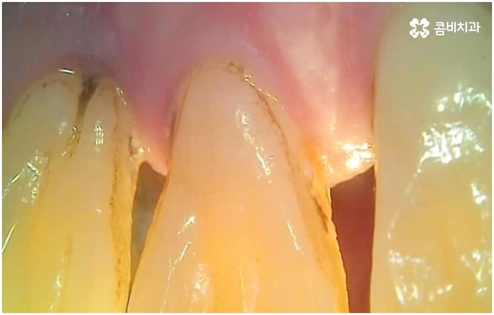 발치후 임플란트 바로 되나요? 관련 이미지 5