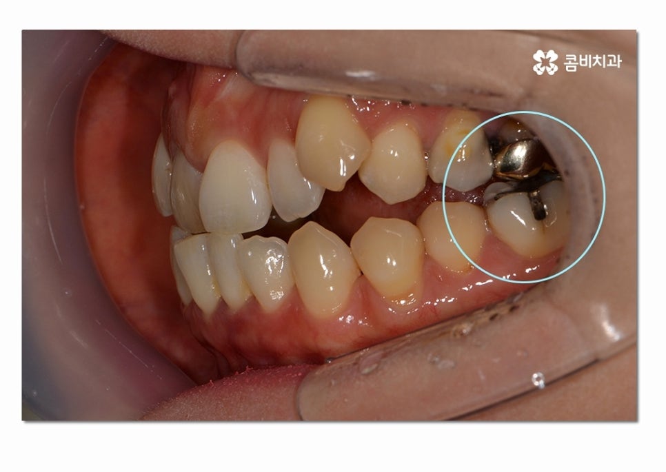 3급 부정교합 지금이라도 고치고 싶다면 관련 이미지 3