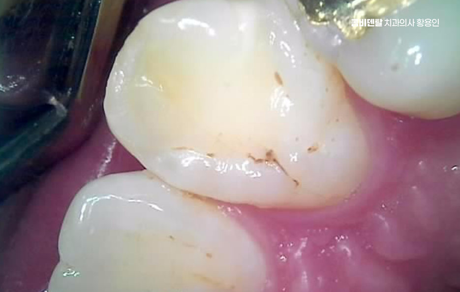 오래된 보철물 아말감 교체 어떠한 케이스일까 관련 이미지 7