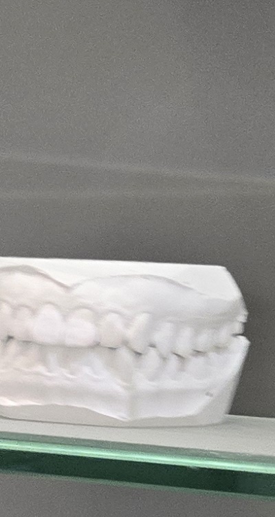 윗니 전체 임플란트 뭐부터 해야할까 관련 이미지 25