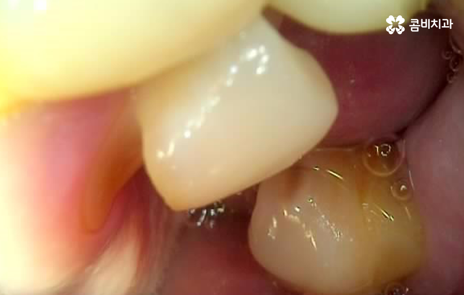 노인임플란트 이때부터 특히 조심하세요 관련 이미지 4