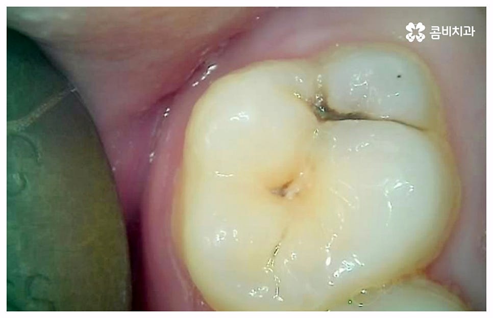 치통이 심할때 어떻게 해야하나요 관련 이미지 5