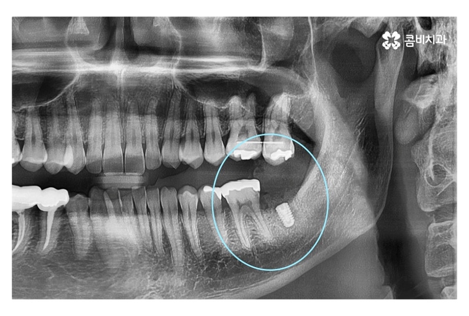 신경치료 후 크라운 시기를 놓치지 않으려면 관련 이미지 8