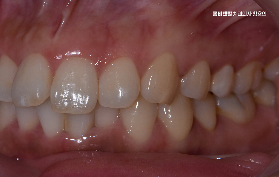 앞니 부분 교정 간단하니까 좋은건가요 관련 이미지 4