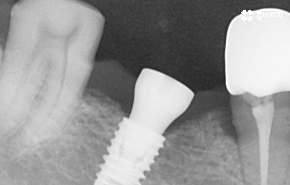 노인임플란트 이때부터 특히 조심하세요 관련 이미지 11