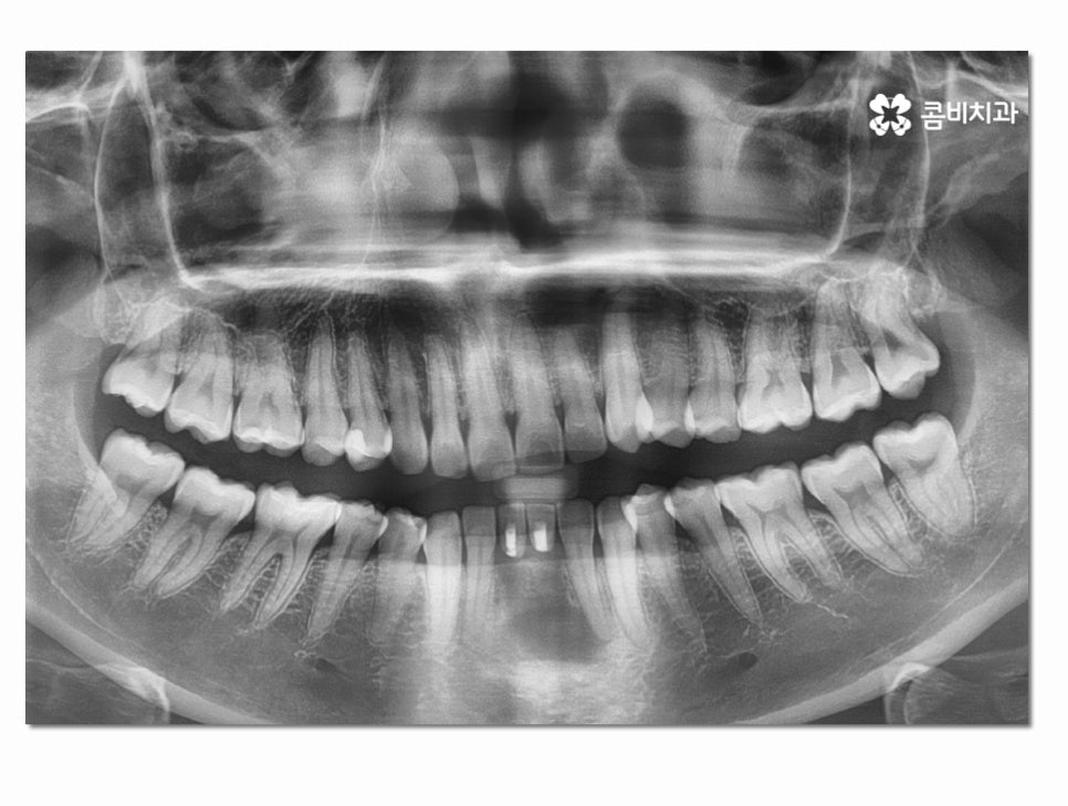 치주염으로 인한 아랫니 임플란트 절차를 알아보면 관련 이미지 4