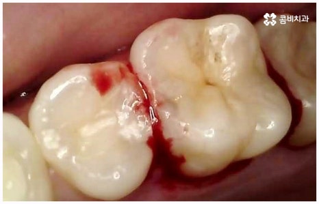 임플란트 종류 어떤게 맞을까요? 관련 이미지 15