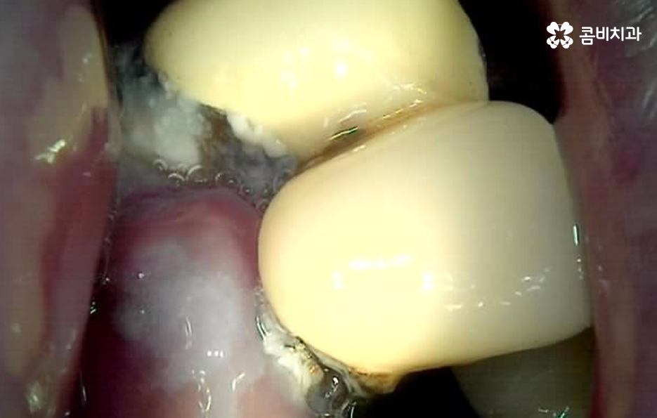 임플란트 나이 얼마나 영향을 줄까 관련 이미지 2