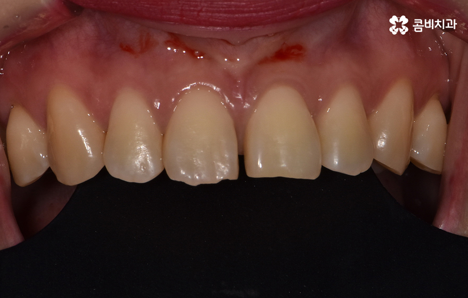 블랙트라이앵글 레진으로 해결한 사례 관련 이미지 5