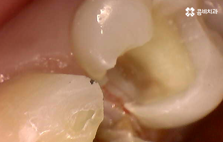 치아 사이 충치 까다로운 이유부터 알아보시죠 관련 이미지 3
