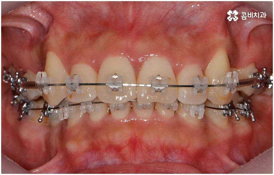돌출치아교정 언제가 좋을까요 관련 이미지 4