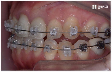 치아교정장치 어떻게 고르나요 관련 이미지 8
