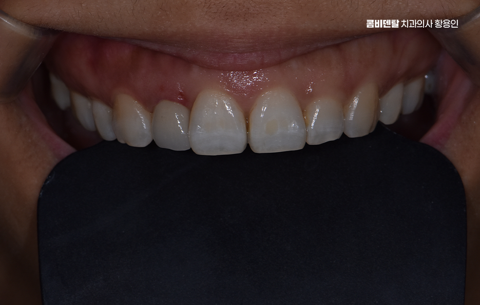 앞니 올세라믹 이건 알고 시작하세요 관련 이미지 7