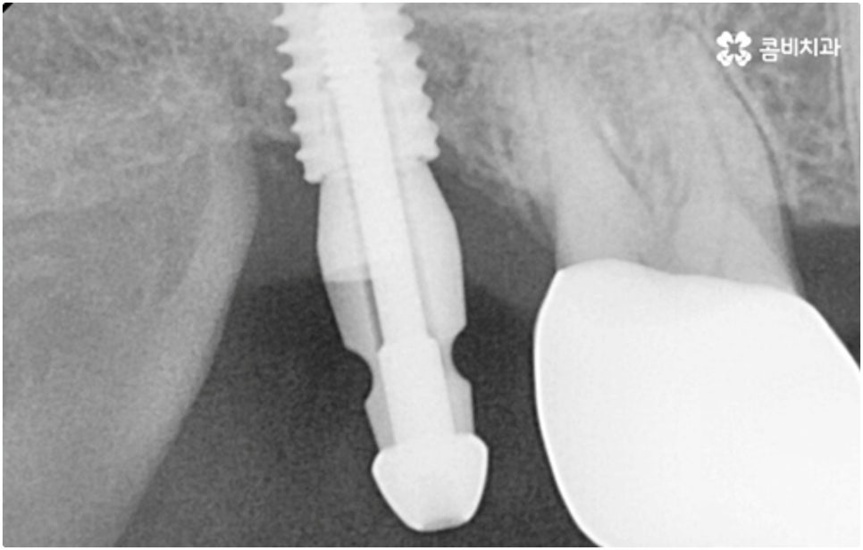 어금니임플란트 살펴볼 사항들은 무엇인가요? 관련 이미지 10