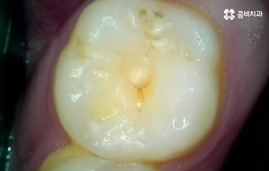 레진 인레이 치료 후 2차충치 왜 발생하고 어떻게 대처할까 관련 이미지 2