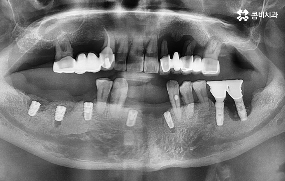 노인임플란트 이것만큼은 기억하세요 관련 이미지 3