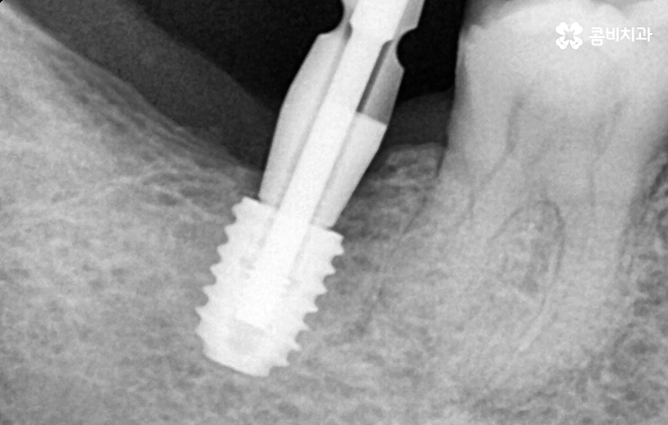 어금니 임플란트 기간 얼마나 예상해야 하나요 관련 이미지 4