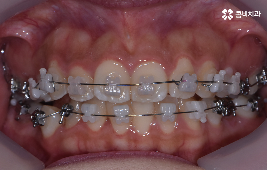 덧니 발치 교정 이런 경우에는 필요합니다 관련 이미지 7