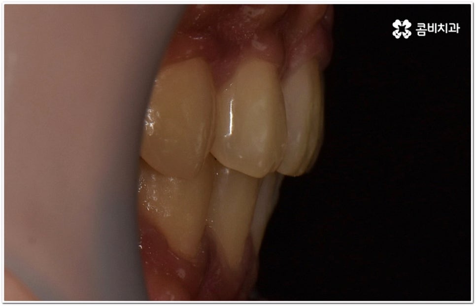 돌출입교정치과 알아보는 기준은 관련 이미지 15
