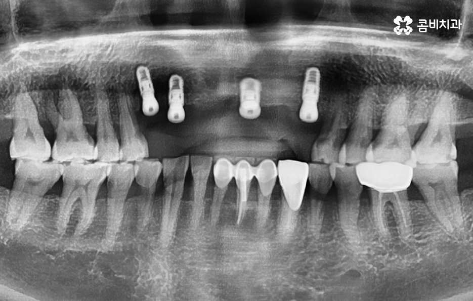 앞니임플란트 이런 조건들을 따져보세요 관련 이미지 7