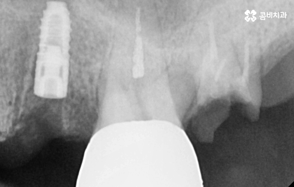 임플란트 치조골 상태에 따라 치료 계획도 달라지나요 관련 이미지 5