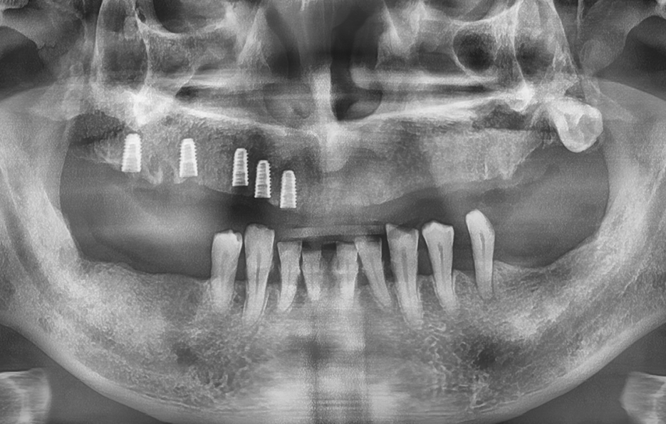 윗니 전체 임플란트 뭐부터 해야할까 관련 이미지 2