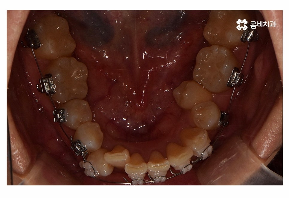 치아설측교정 가능한지 궁금하다면 관련 이미지 9