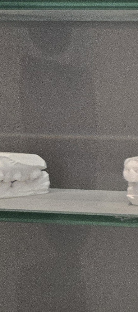 앞이빨 임플란트 과정 주의해야할 포인트는 관련 이미지 19