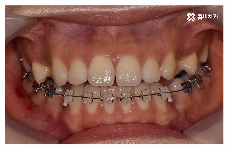 돌출입치아교정 적극적으로 해결하려면 관련 이미지 6