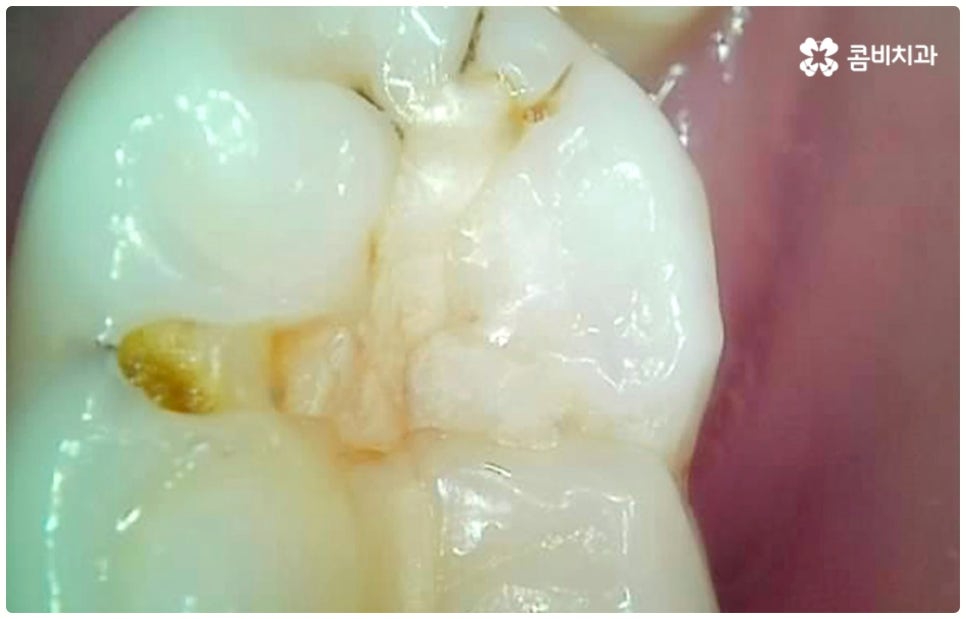 충치치료종류 알아볼까요? 관련 이미지 5
