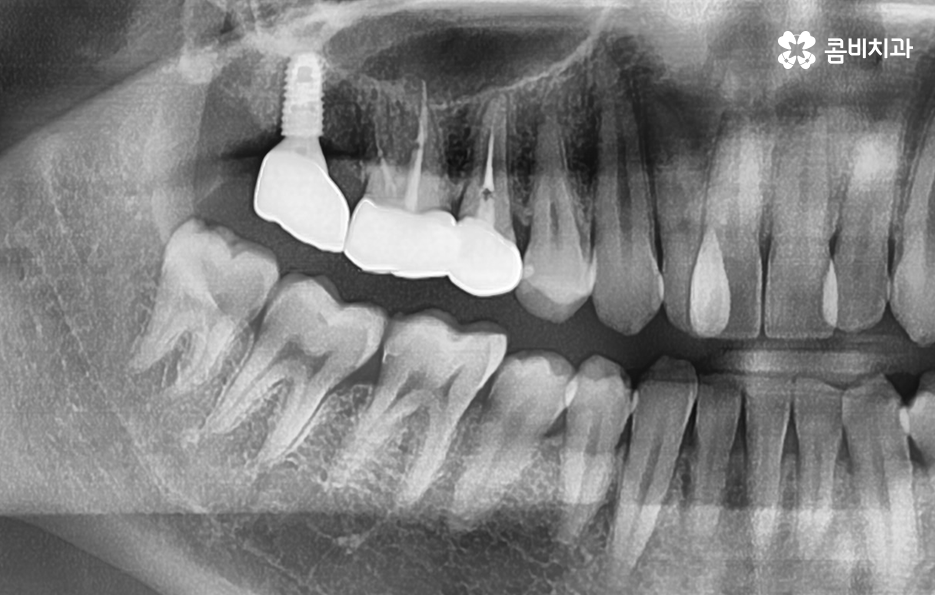 어금니 충치 발치 결국 뽑아야 할때와 살릴 수 있는 케이스 관련 이미지 9