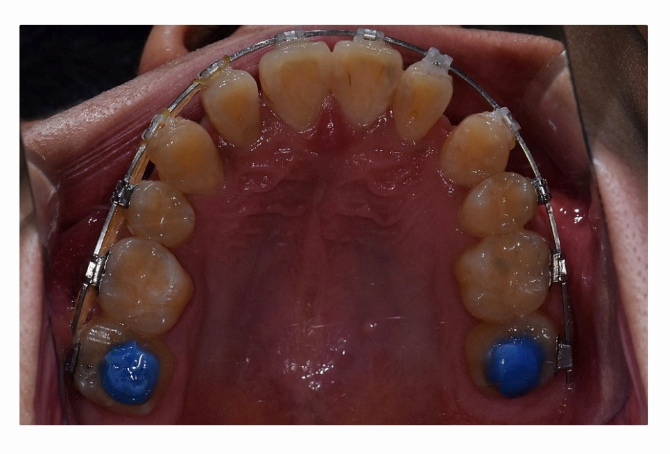 덧니 발치 필수적으로 하는건가요 관련 이미지 18