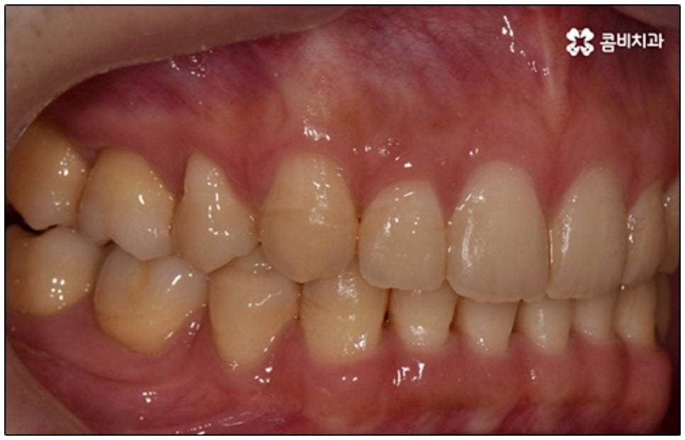 클리피씨교정 알아봐야 할것들 관련 이미지 10
