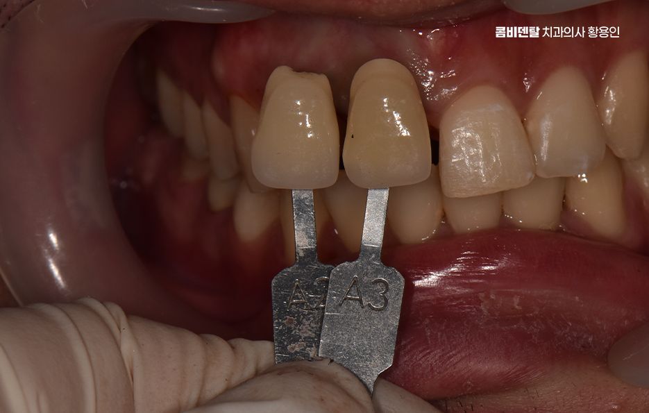 깨진 앞니 크라운 어떻게 해야 깔끔하게 해결될까 관련 이미지 8