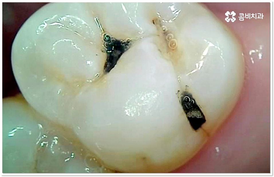 어금니 충치치료 빠를수록 좋아요 관련 이미지 2