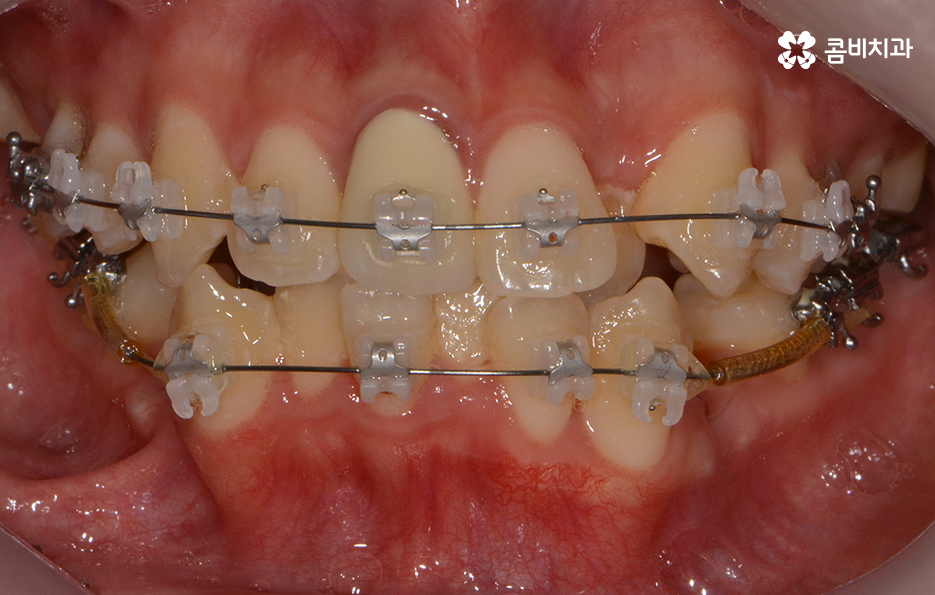 덧니교정 불편함이 느껴지지 않더라도 관련 이미지 7