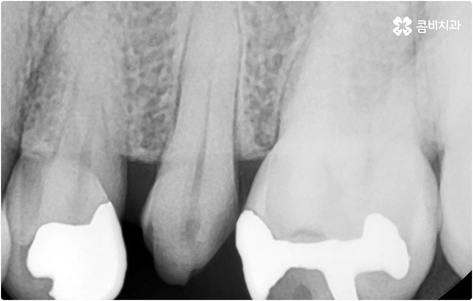 20대임플란트 남의일이 아니라면 관련 이미지 2