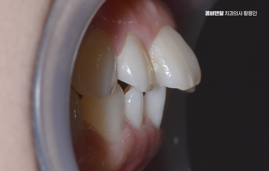 앞니 부분 교정 간단하니까 좋은건가요 관련 이미지 2