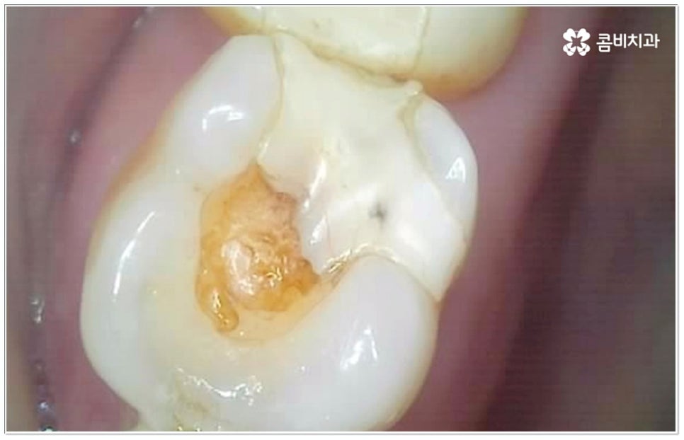 충치 인레이 언제 받나요? 관련 이미지 7